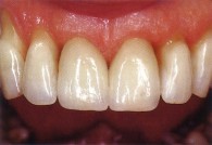 протезирования зубов металлокерамикой